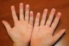 Avuç İçi Nasır Belirtileri ve Tedavisi