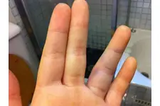 Elde Nasır Belirtileri ve Tedavisi