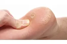 Nasır Kaşıntısı Belirtileri ve Tedavisi